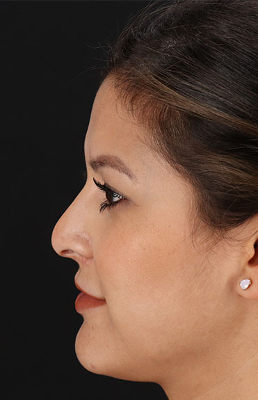 Before - left_lateral