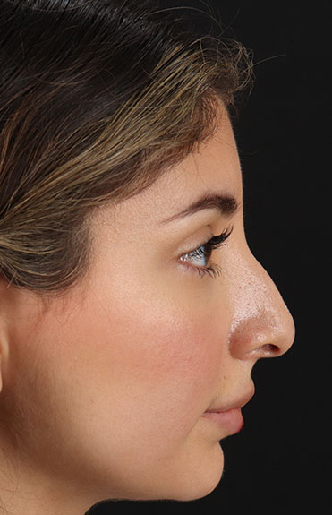 Before - right_lateral