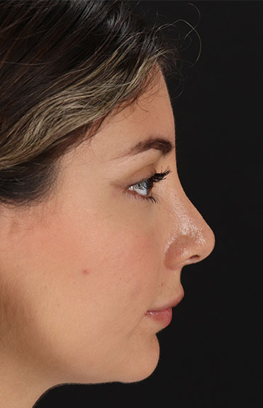 After - right_lateral