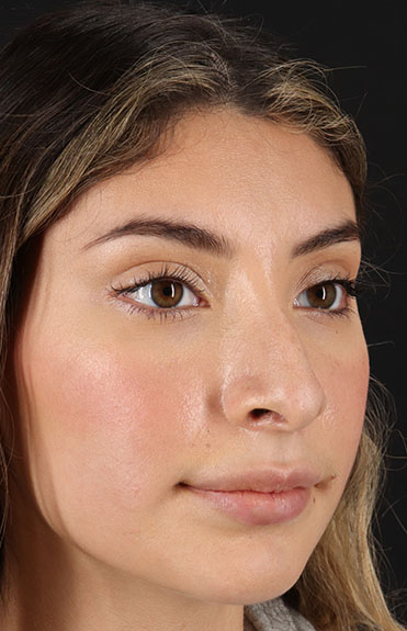 Before - right_oblique