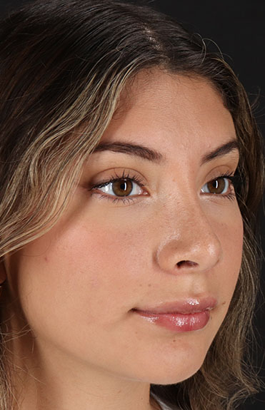 After - right_oblique