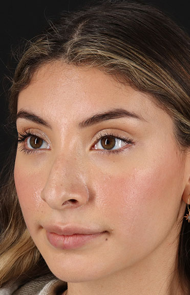 Before - left_oblique