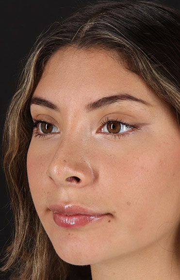 After - left_oblique