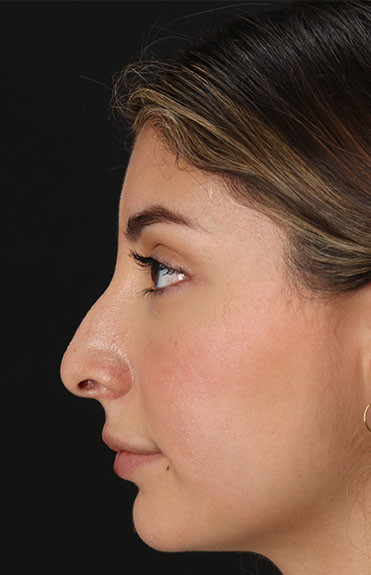 Before - left_lateral