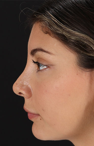 After - left_lateral