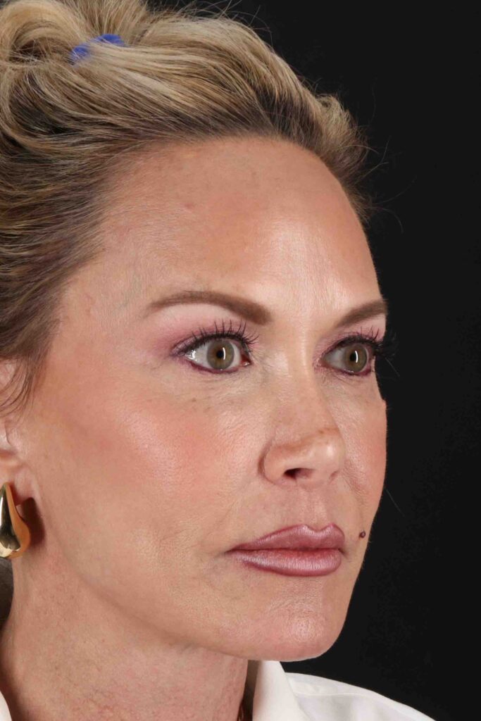 After - right_oblique