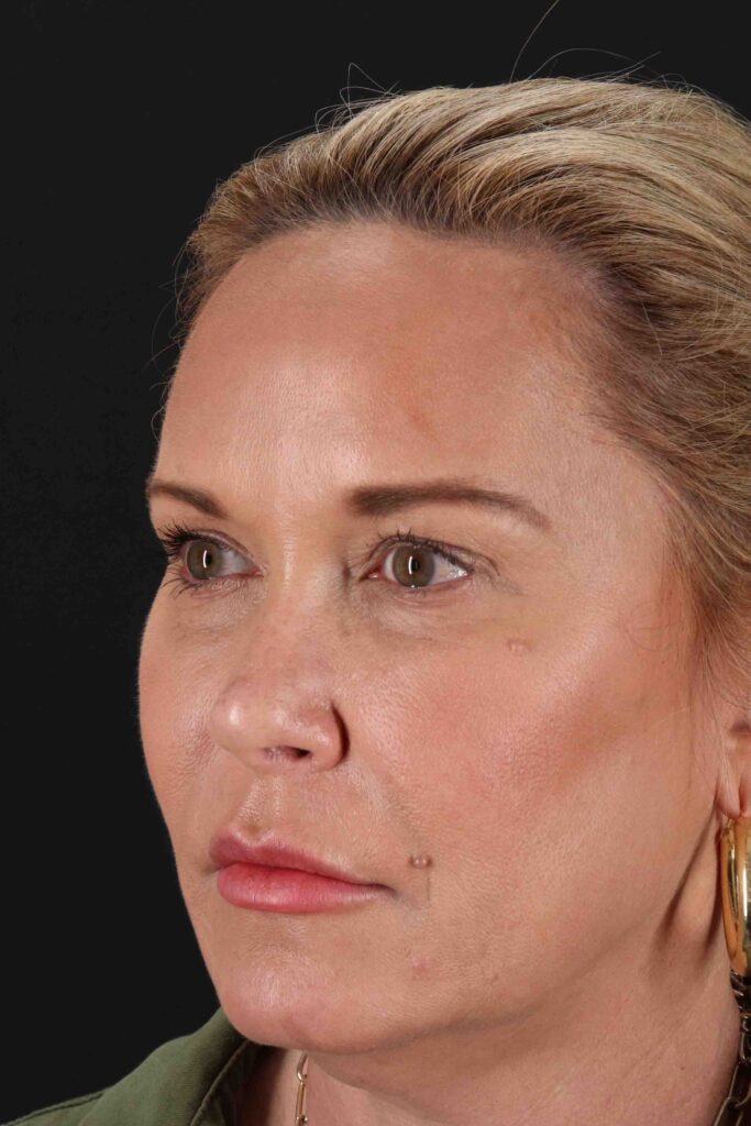 Before - left_oblique