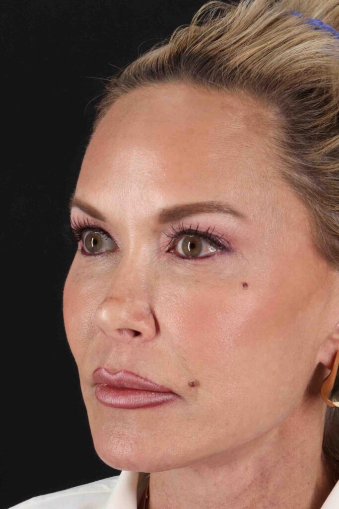 After - left_oblique