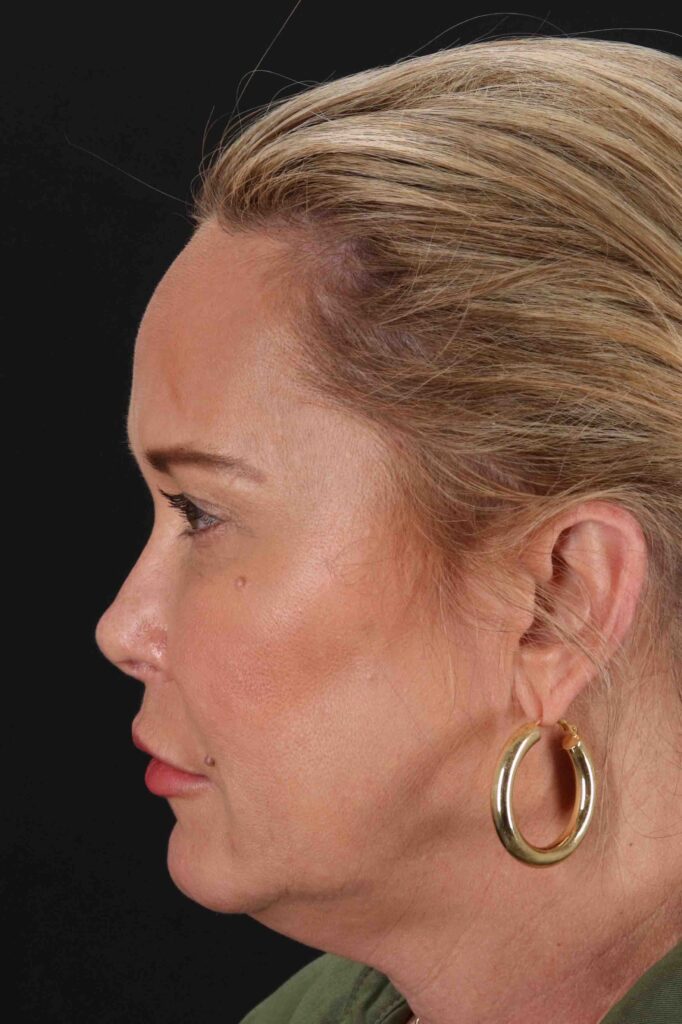 Before - left_lateral