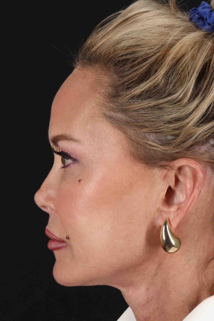 After - left_lateral