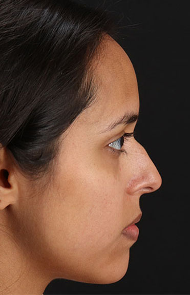 Before - right_lateral