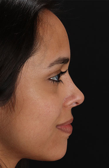 After - right_lateral