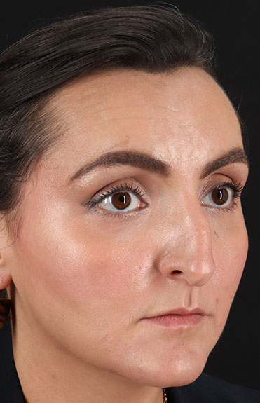 Before - right_oblique