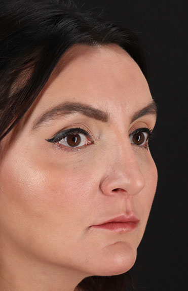 After - right_oblique