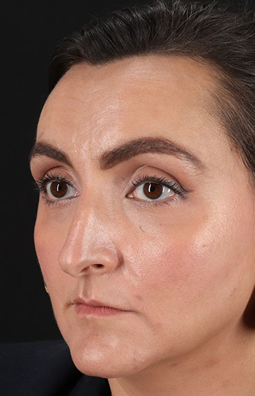 Before - left_oblique