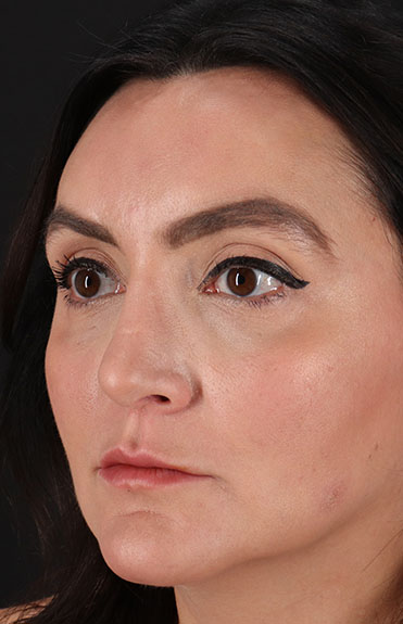 After - left_oblique