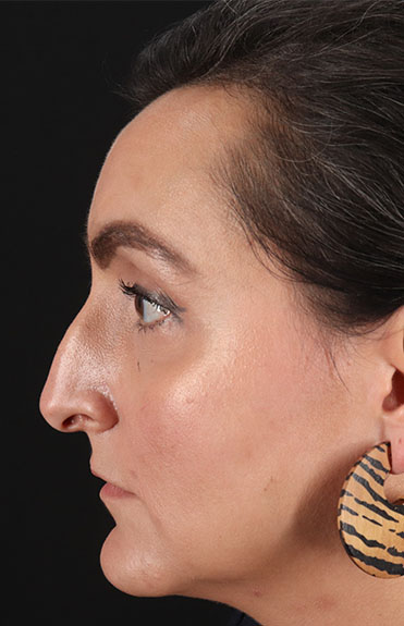 Before - left_lateral