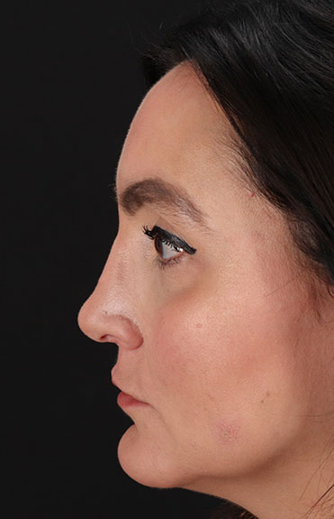 After - left_lateral