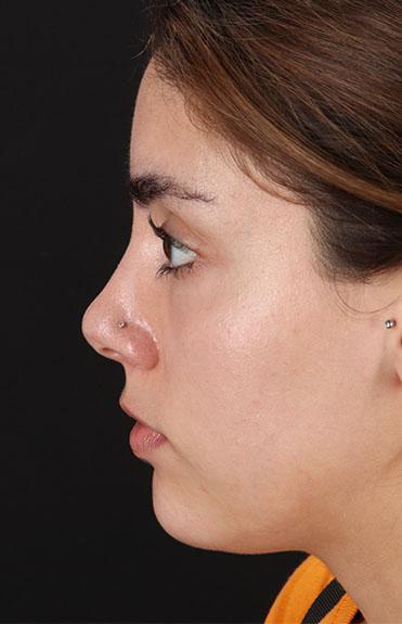 Before - left_lateral