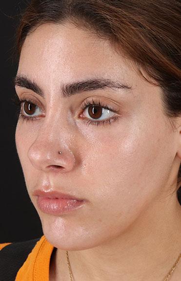 Before - left_oblique