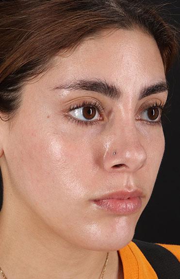 Before - right_oblique