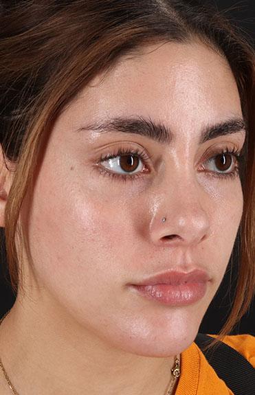 After - right_oblique