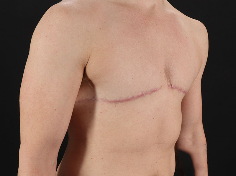 After - right_oblique