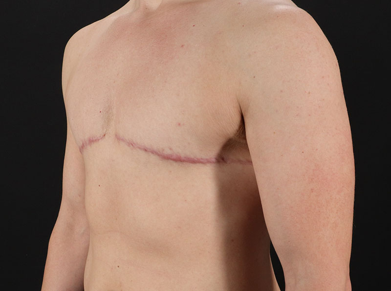 After - left_oblique