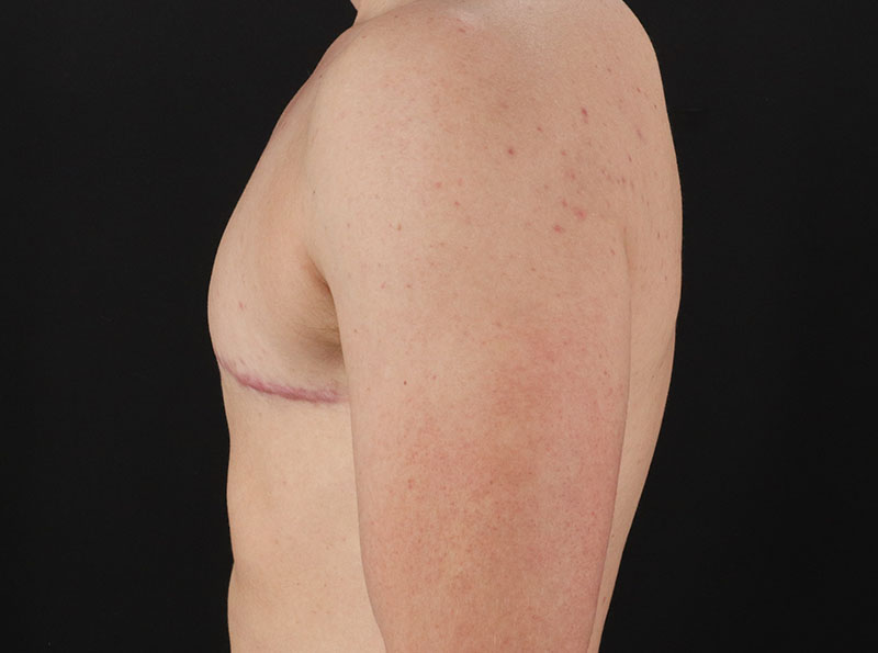 After - left_lateral