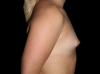 Before - right_lateral