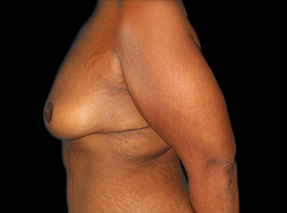 After - left_lateral