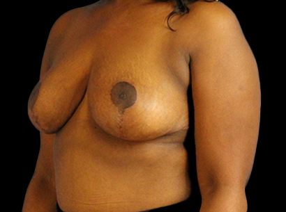 After - left_oblique