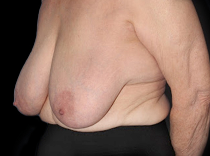 Before - left_oblique