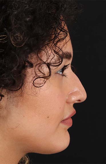 Before - right_lateral