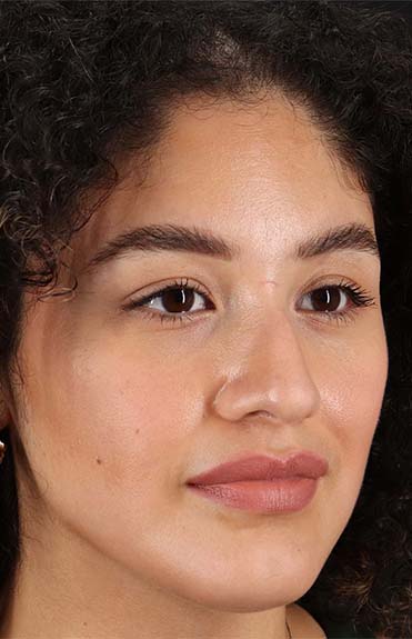 Before - right_oblique