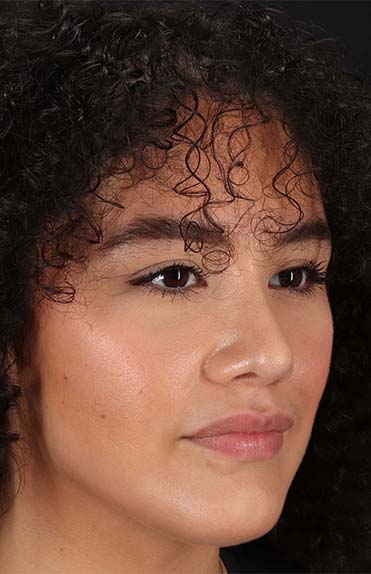 After - right_oblique