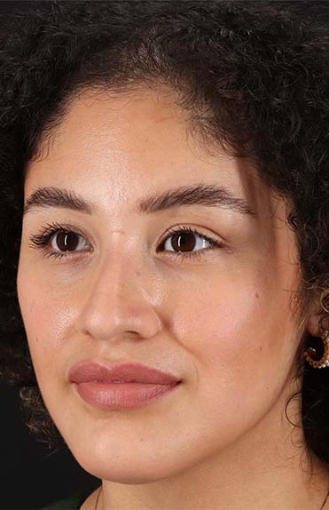 Before - left_oblique