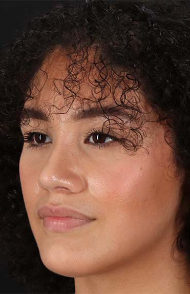 After - left_oblique