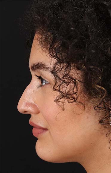 Before - left_lateral