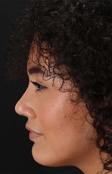 After - left_lateral