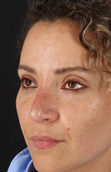 After - left_oblique