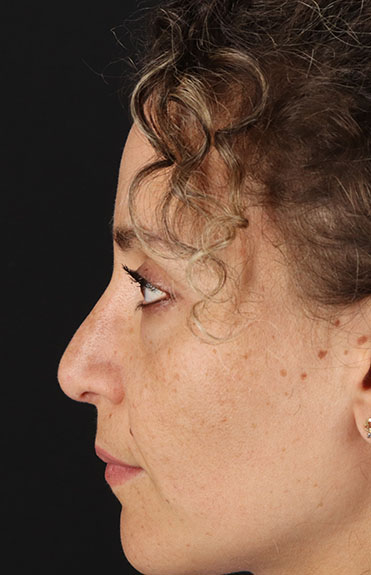 Before - left_lateral