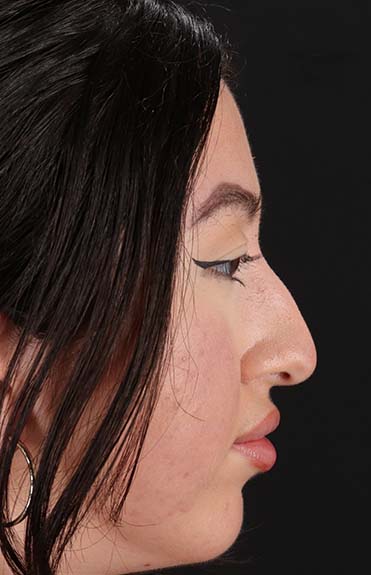 Before - right_lateral