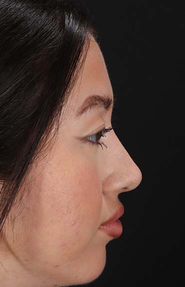 After - right_lateral