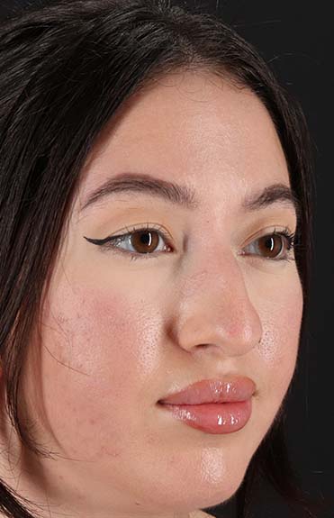 Before - right_oblique