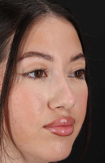 After - right_oblique