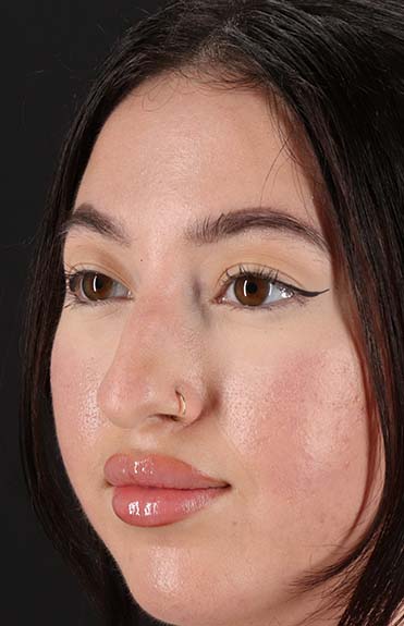 Before - left_oblique