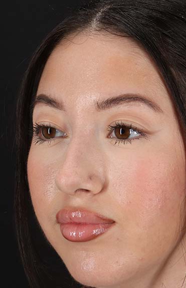 After - left_oblique