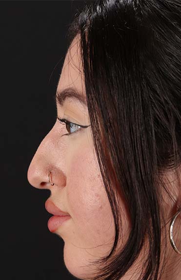 Before - left_lateral