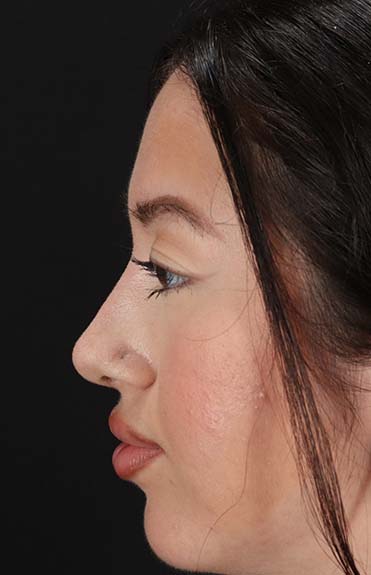 After - left_lateral